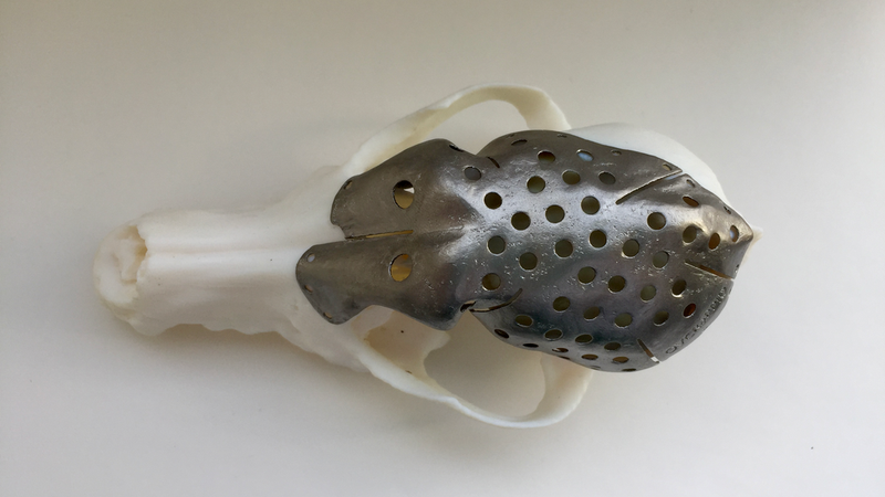 The custom-built, 3D-printed titanium skull cap.